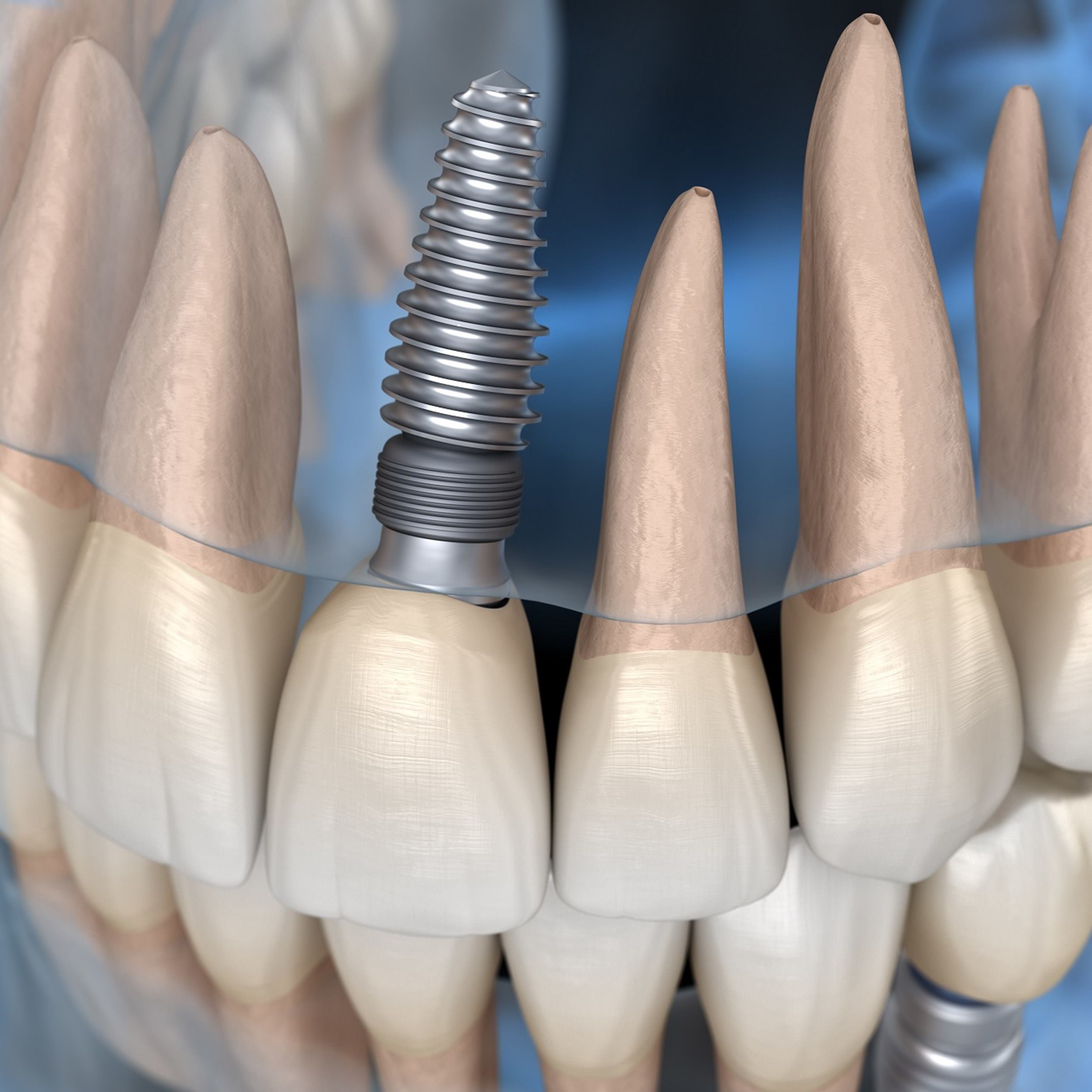 implantes_dentales_dientes