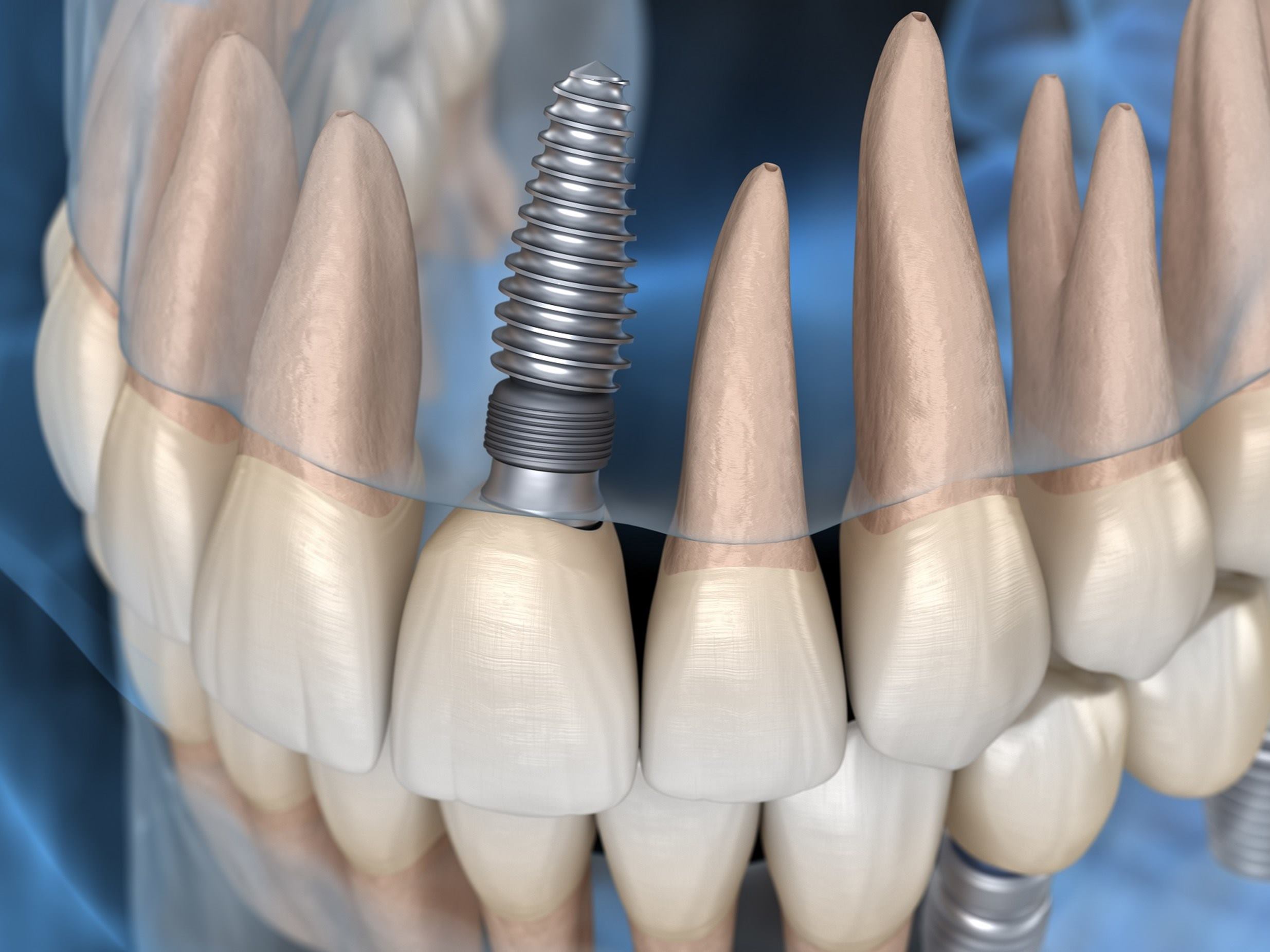 implantes_dentales_dientes